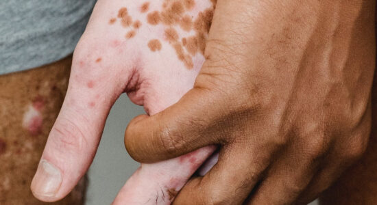 psoriasi