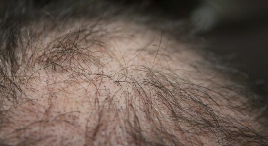 caduta dei capelli