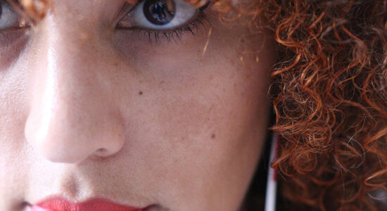 melasma