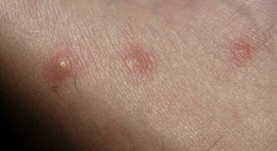 reazioni allergiche