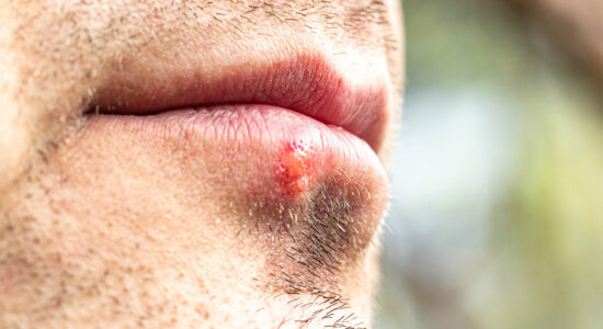 herpes