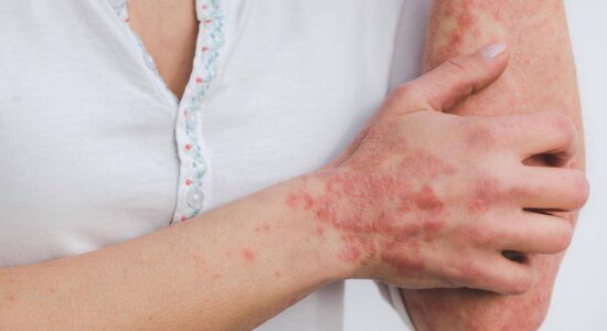 psoriasi pelle