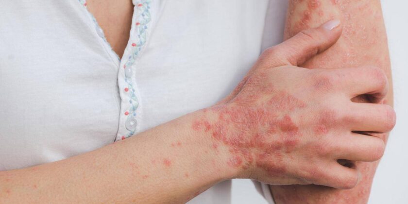 psoriasi pelle