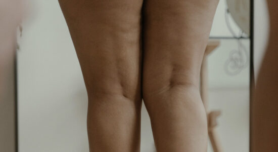cellulite