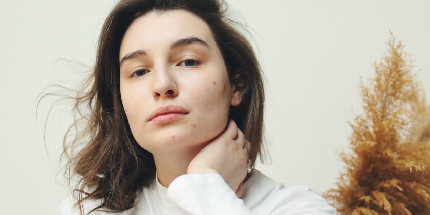 pelle con couperose o rosacea