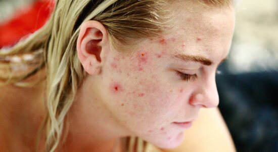 Se non sopporti più brufoli e acne sul viso ecco cosa fare-proiezionidiborsa.it