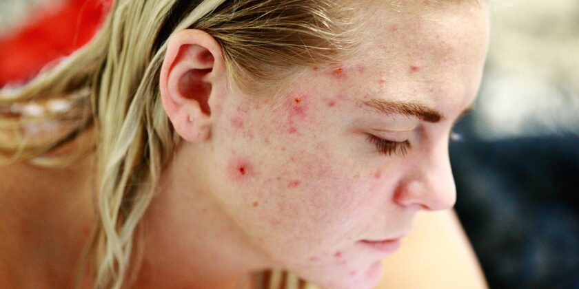 Se non sopporti più brufoli e acne sul viso ecco cosa fare-proiezionidiborsa.it