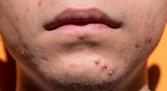 Pelle secca e tanta acne-proiezionidiborsa.it