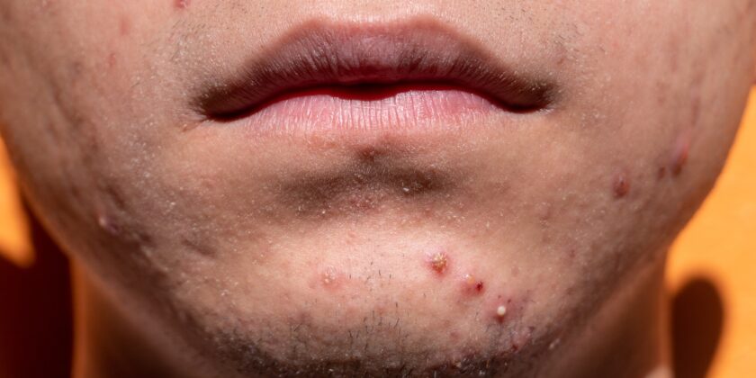 Pelle secca e tanta acne-proiezionidiborsa.it
